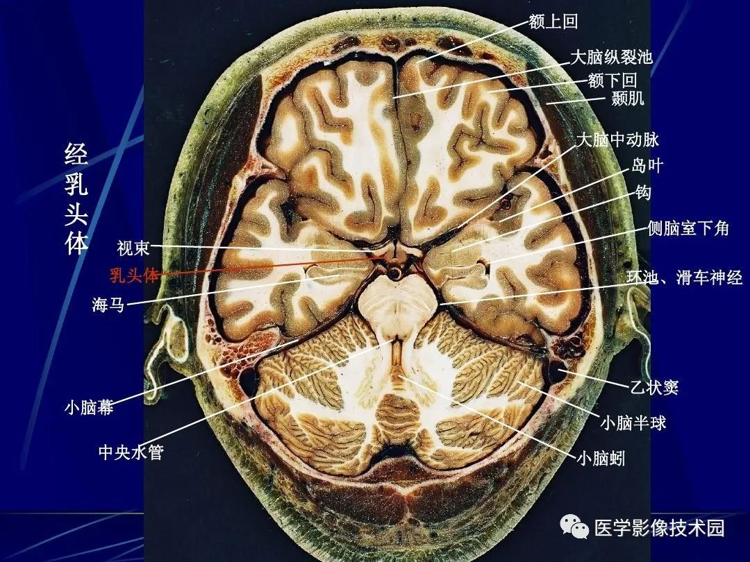 第三节 颅脑正常磁共振表现