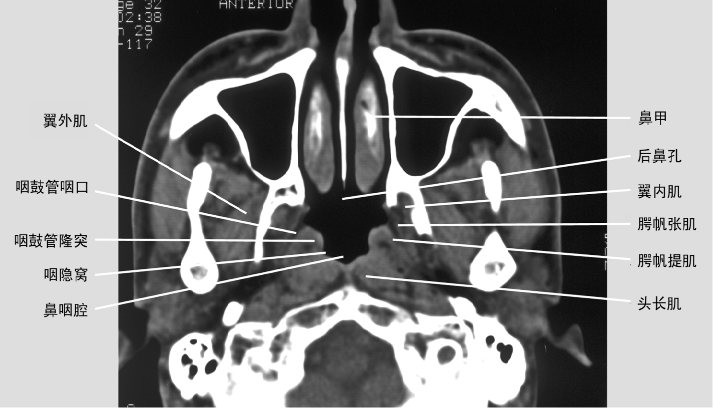 鼻咽部的CT解剖 _咽部ct解剖圖 - 可爾網