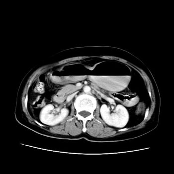 胃肠道CT影像.png